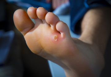 Kurie oko: Takto sa ho zbavíš rýchlo, jednoducho a bez bolesti!