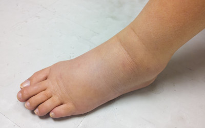 Zadržiavanie vody v tele: Máme užitočné rady, ako sa ho zbaviť