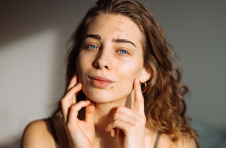 Šok pre ženy po tridsiatke: Akné nemizne, ale zhoršuje ho jedna chyba, ktorú robíme všetky!