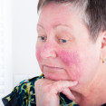 Rosacea: Nepríjemné ochorenie, ktoré si ľahko pomýliš s akné!