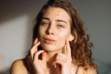 Šok pre ženy po tridsiatke: Akné nemizne, ale zhoršuje ho jedna chyba, ktorú robíme všetky!