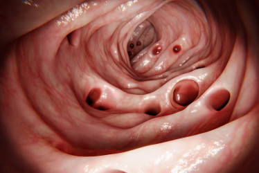 Vieš, čo je divertikulóza? Zisti, ktorú časť tela môže postihnúť!