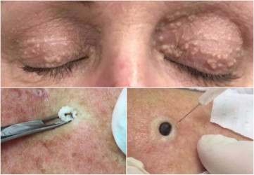 Lipómy, akné, mílie: Tieto videá sledujú tisícky ľudí! Ale, prečo?