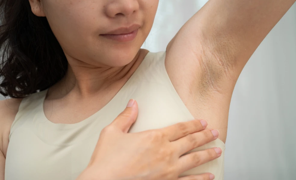 tmavšia pokožka v podpazuší