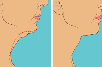 Dvojitá brada ťa už nemusí viac trápiť. Takto sa jej zbavíš!