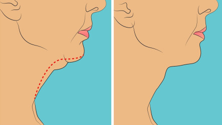 Dvojitá brada ťa už nemusí viac trápiť. Takto sa jej zbavíš!