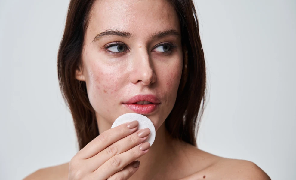 chyby v starostlivosti o pleť s akné