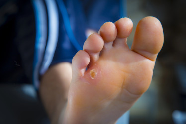 Kurie oká: S ktorými prírodnými zložkami ich vyliečiš?