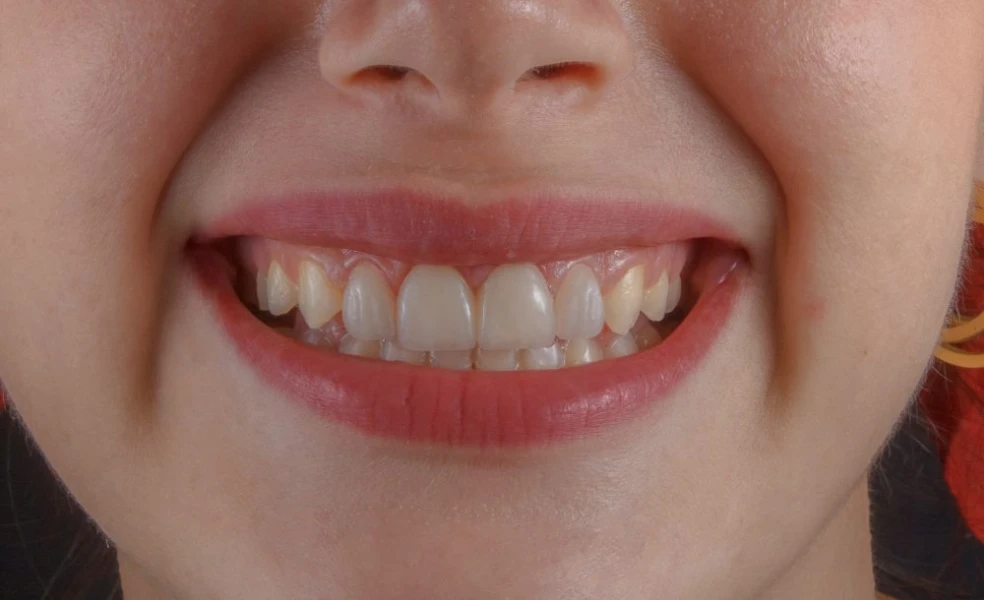 prečo nevynechávať dentálnu hygienu