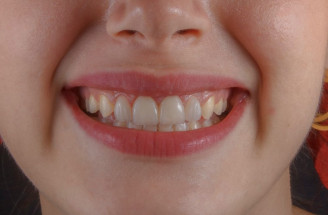 Nechodíte na dentálnu hygienu? 5 dôvodov, prečo može trpieť váš úsmev