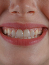 Nechodíte na dentálnu hygienu? 5 dôvodov, prečo može trpieť váš úsmev