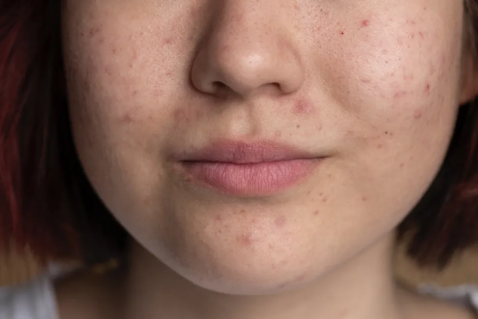 akné a make-up