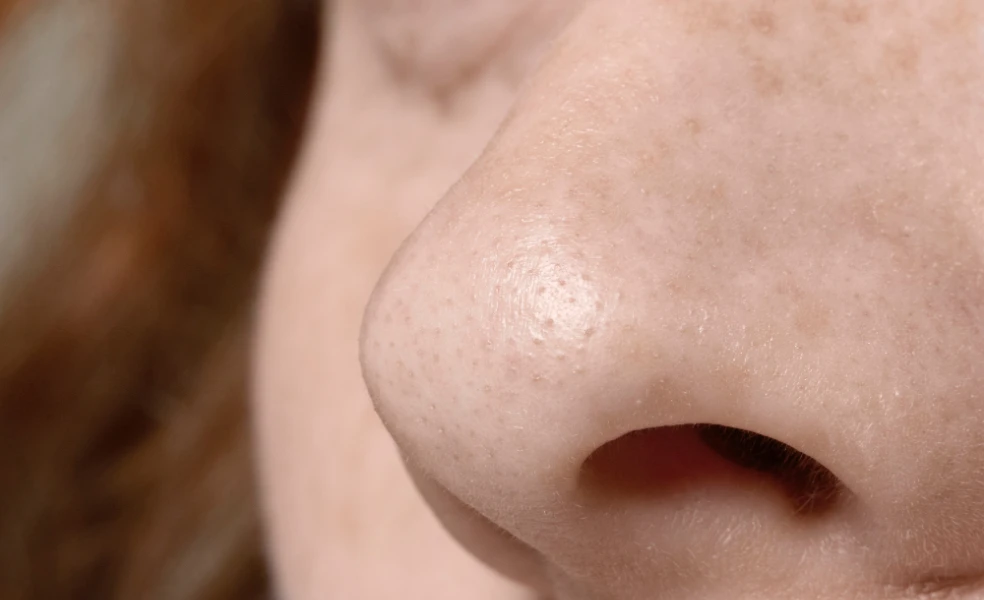 upchaté póry v prechodnom období