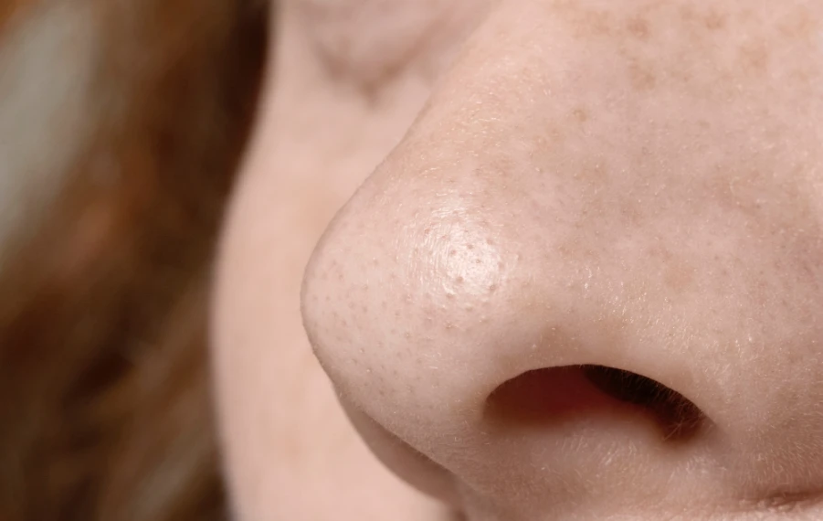 upchaté póry v prechodnom období