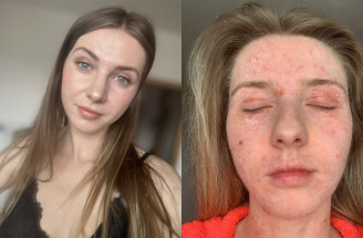„Nemohla som spať ani sa hýbať bez bolesti.“ Nikol Macháčková otvorene o ekzéme, TSW aj psychike