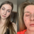 „Nemohla som spať ani sa hýbať bez bolesti.“ Nikol Macháčková otvorene o ekzéme, TSW aj psychike