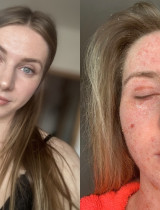 „Nemohla som spať ani sa hýbať bez bolesti.“ Nikol Macháčková otvorene o ekzéme, TSW aj psychike