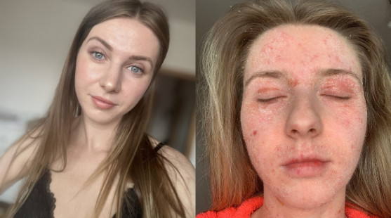 „Nemohla som spať ani sa hýbať bez bolesti.“ Nikol Macháčková otvorene o ekzéme, TSW aj psychike