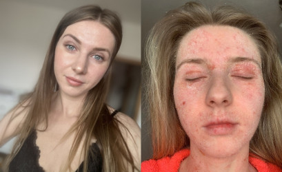„Nemohla som spať ani sa hýbať bez bolesti.“ Nikol Macháčková otvorene o ekzéme, TSW aj psychike
