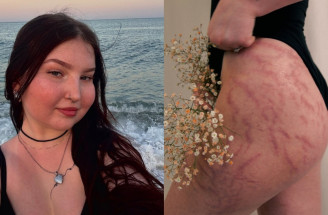 Karin Skopcová otvorene o Crohnovej chorobe: „Bála som sa, že prídem o svoj život. A vlastne sa to aj stalo.“