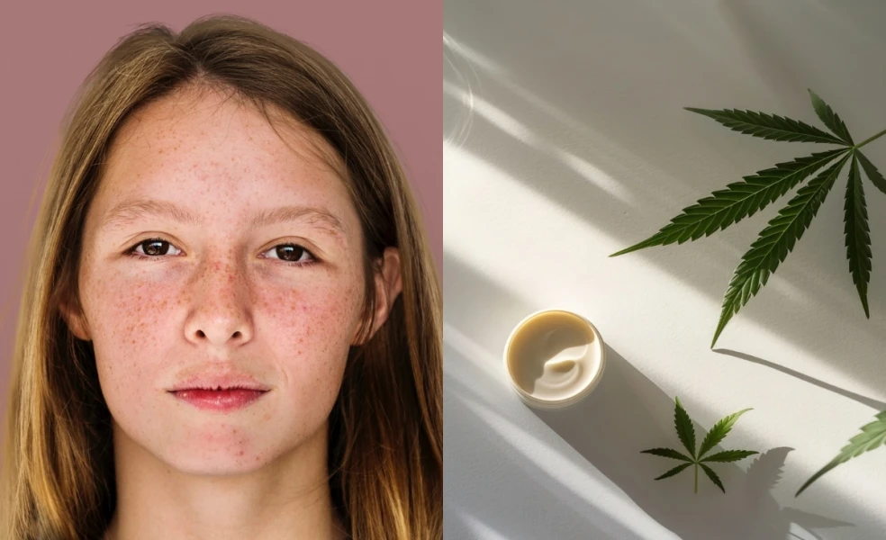 marihuana a pleť – žena s konope listom pri tvári, ilustračný obrázok k článku o vplyve THC a CBD na akné, vrásky a stav pokožky