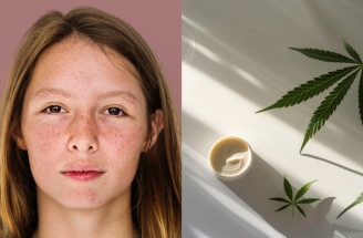 Marihuana a pleť: Môže THC spôsobovať akné, vrásky a zhoršiť stav pokožky?