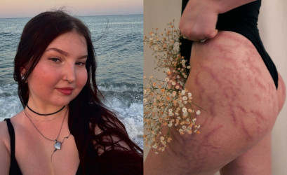 Karin Skopcová otvorene o Crohnovej chorobe: „Bála som sa, že prídem o svoj život. A vlastne sa to aj stalo.“