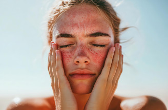 Rosacea v lete: Prečo sa pleť zhoršuje aj vtedy, keď poctivo používate SPF? Odborníci vysvetľujú skutočného vinníka
