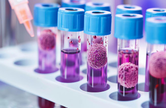 Tekutá biopsia: Revolúcia v diagnostike rakoviny? AI dokáže odhaliť nádor z krvi