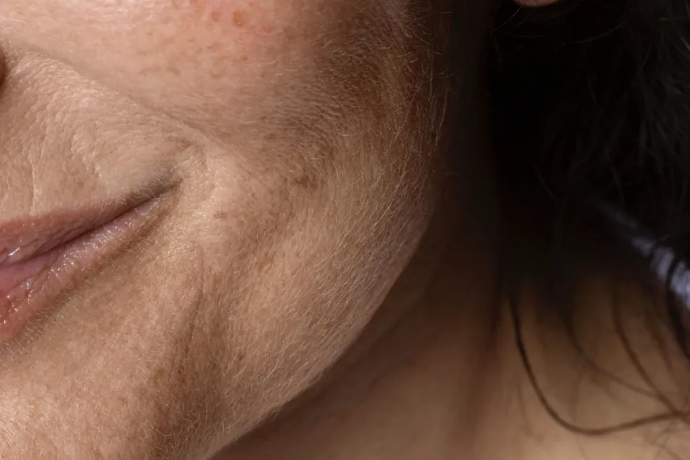 suchá a dehydratovaná pleť počas perimenopauzy a menopauzy