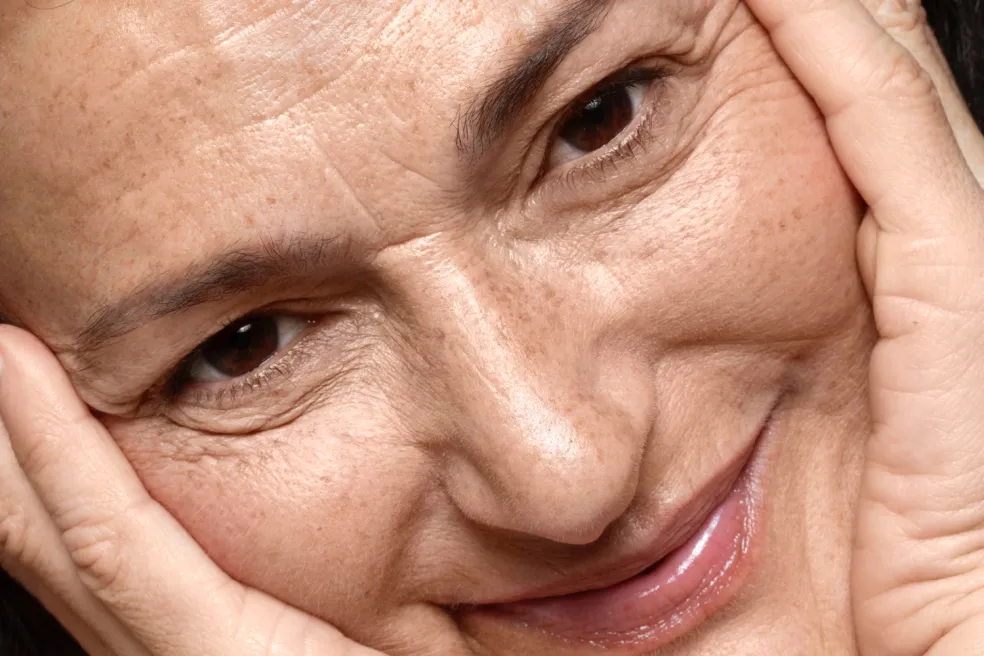 pigmentové škvrny na zrelej pleti počas menopauzy