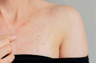 Akné na hrudi: Prečo vzniká, čo naň pomáha a kedy ísť k dermatológovi?