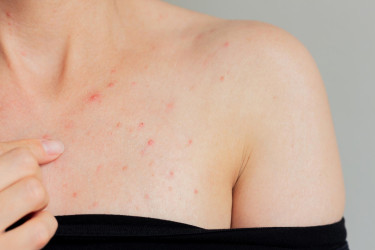 Akné na hrudi: Prečo vzniká, čo naň pomáha a kedy ísť k dermatológovi?