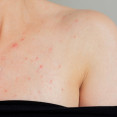 Akné na hrudi: Prečo vzniká, čo naň pomáha a kedy ísť k dermatológovi?