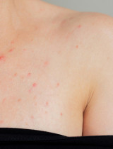 Akné na hrudi: Prečo vzniká, čo naň pomáha a kedy ísť k dermatológovi?