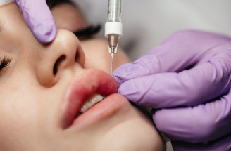 Lip flip: rozdiel oproti výplni pier, limity a riziká