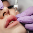 Lip flip: rozdiel oproti výplni pier, limity a riziká