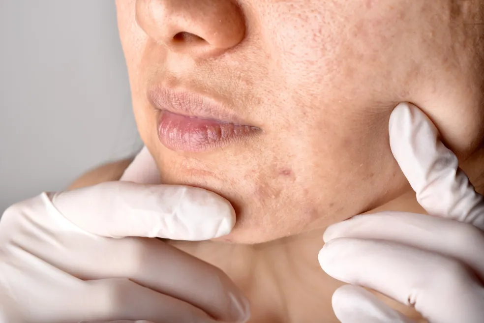 Detail dermatologického vyšetrenia tváre ženy s viditeľnými pórmi, nerovnomernou textúrou pleti a stopami po akné na lícach a brade