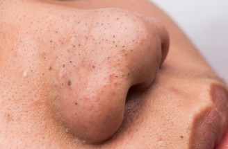 Čierne bodky: čo pomáha na upchaté póry a čomu sa vyhnúť