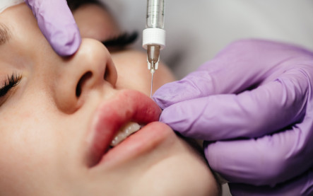 Lip flip – prirodzené pery ženy pred konzultáciou estetického zákroku s botulotoxínom